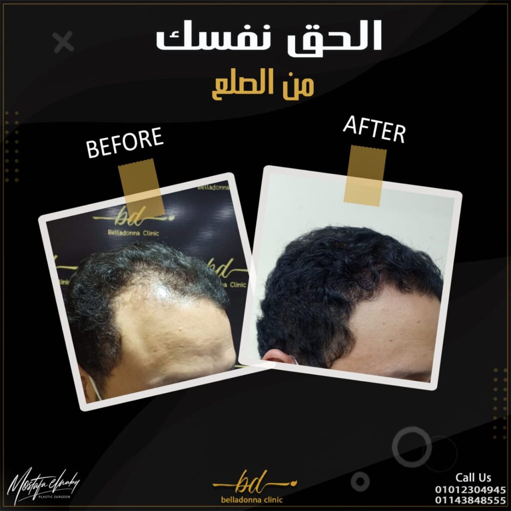 عملية زراعة الشعر