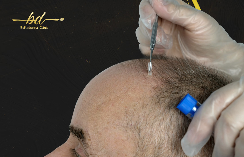 انواع زراعة الشعر