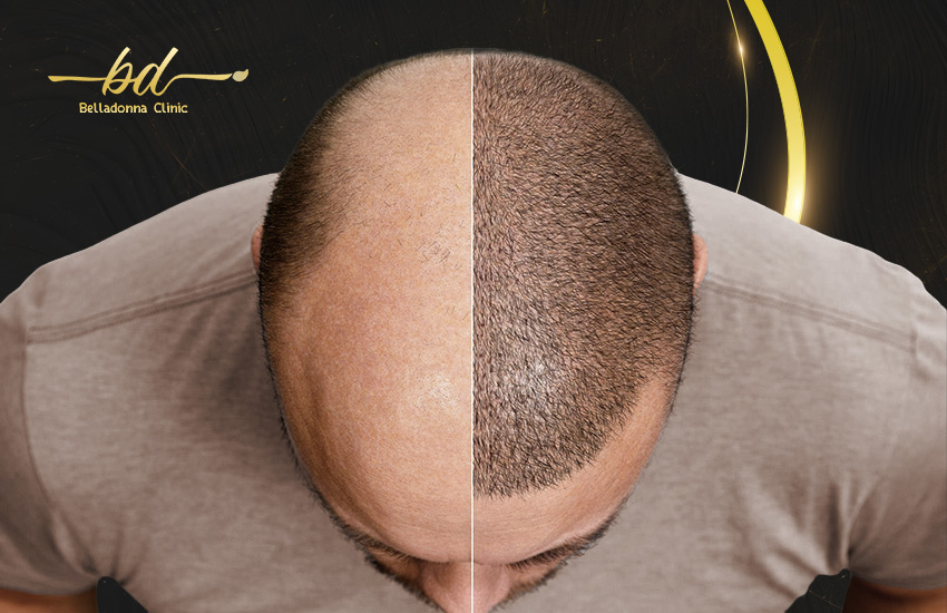 زراعة الشعر قبل وبعد