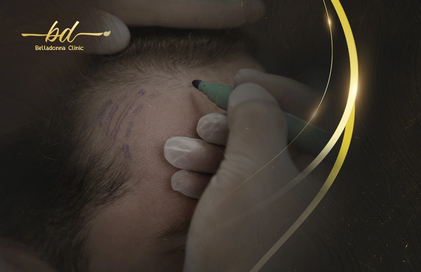 تصغير الجبهه بزراعة الشعر