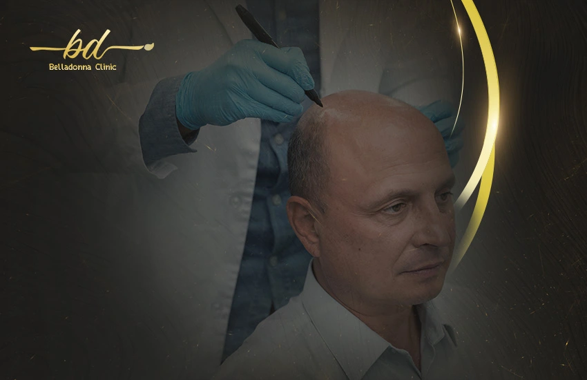 بعد عملية زرع الشعر