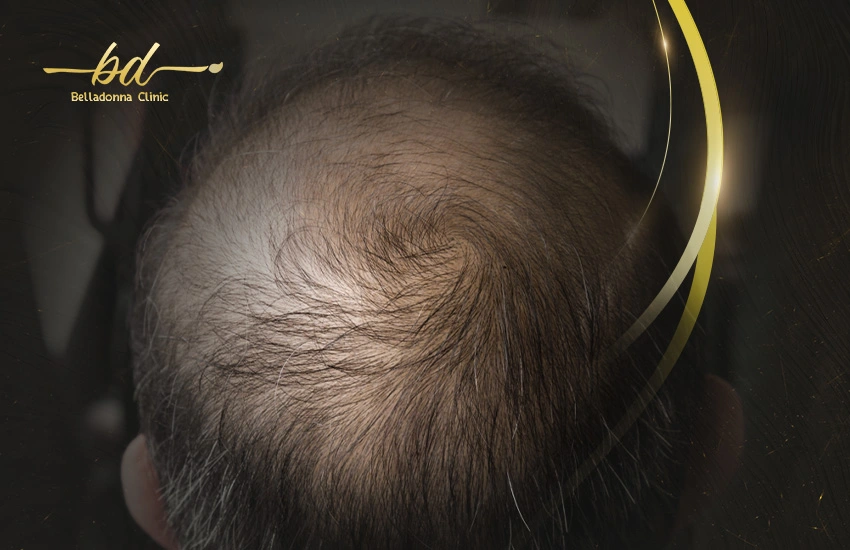 زراعة الشعر الخفيف