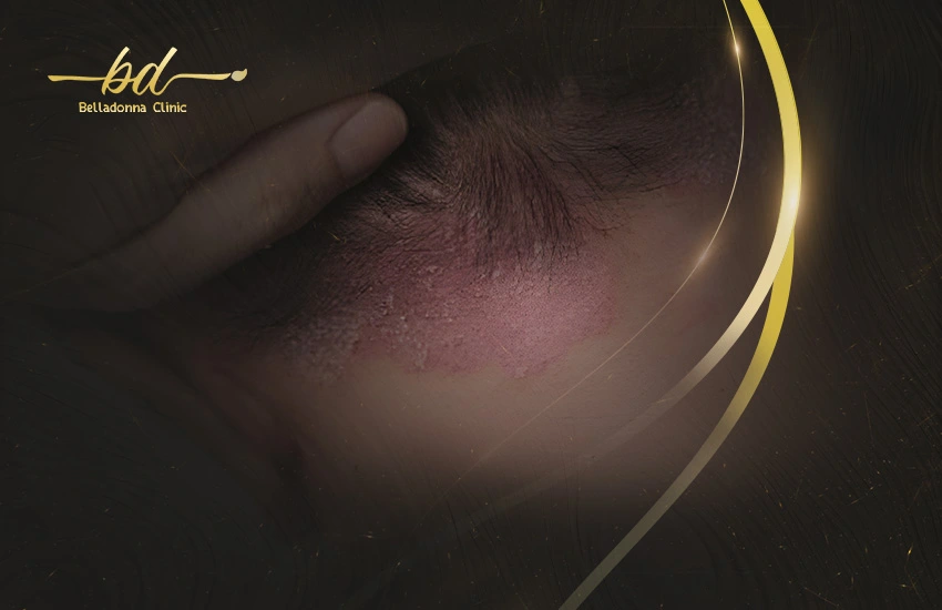 زراعة الشعر لمرضي الصدفية