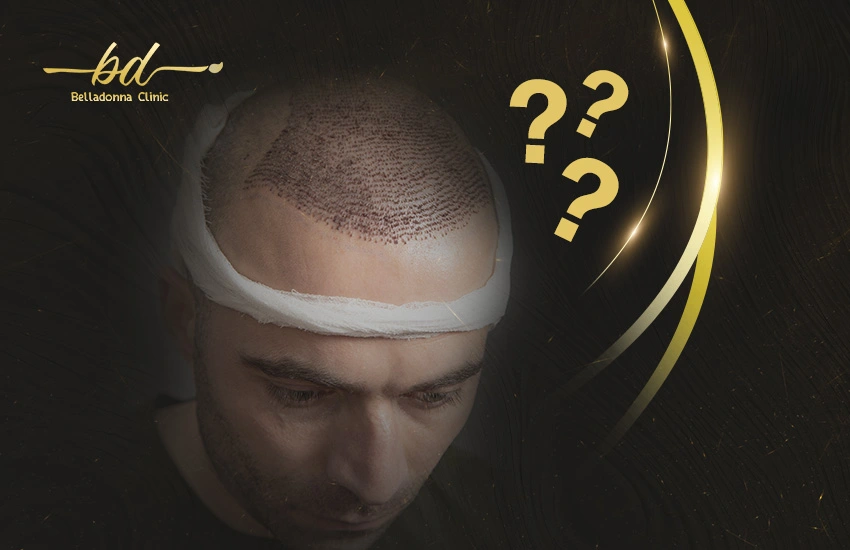 متى-يمكن-العودة-للحياة-العادية-بعد-زراعة-الشعر متى يمكن العودة للحياة العادية بعد زراعة الشعر