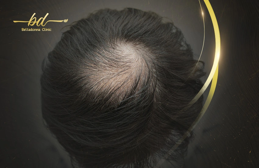زراعة الشعر في منطقة التاج