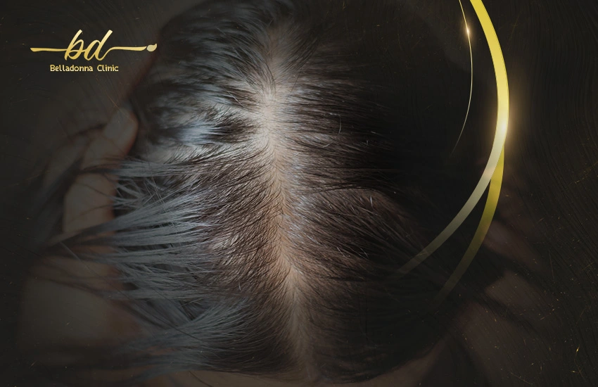 علاج الصلع الوراثي عند النساء