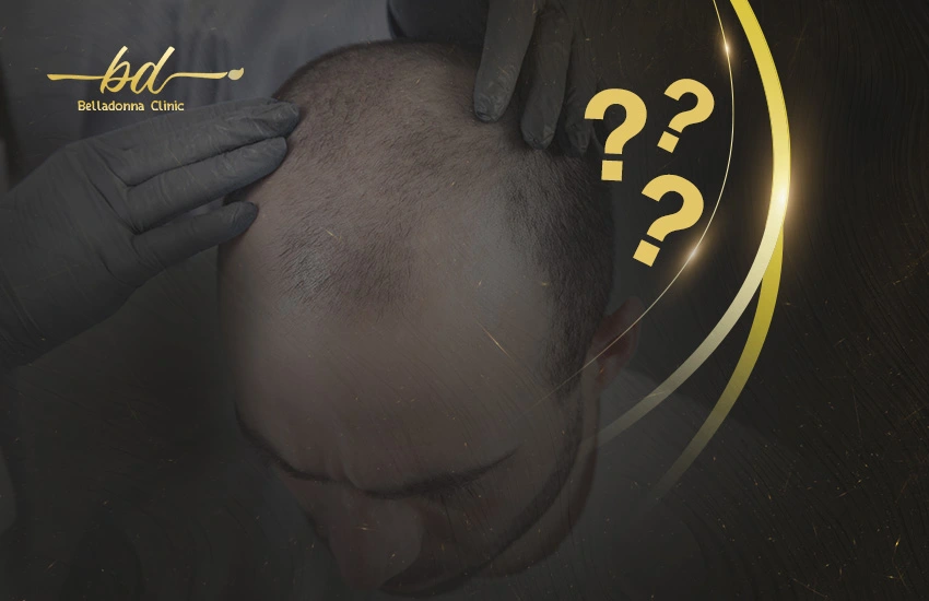 تأخر نمو الشعر المزروع