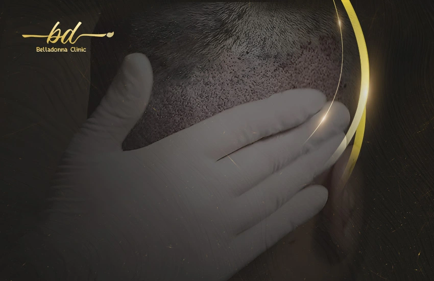 تدليك الرأس بعد زراعة الشعر