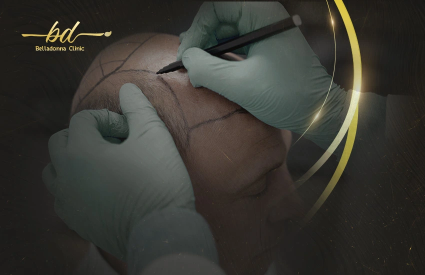 مراحل نمو الشعر بعد الزراعة بالصور