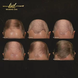 مراحل نمو الشعر بعد الزراعة بالصور