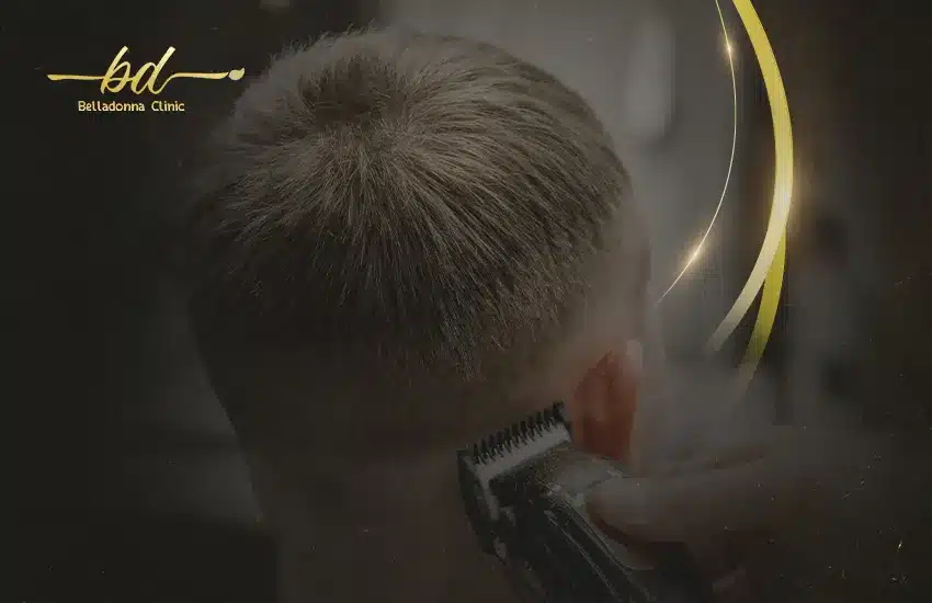 حلاقة الشعر بعد الزراعة